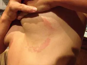 Person showing a red rash on skin.