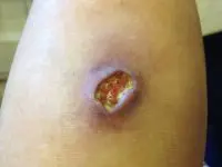 Skin lesion with surrounding redness and bruising.